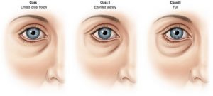 Preenchimento de olheira com ácido hialurônico