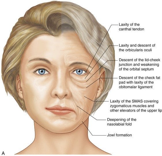 botox para queixo e canto da boca para DAO e mentalis