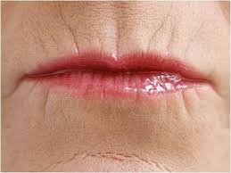 botox para rugas no lábio e boca botox para rugas no lábio e boca em linhas periorais