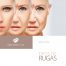 Tipos de rugas: rugas dinâmicas e rugas estáticas