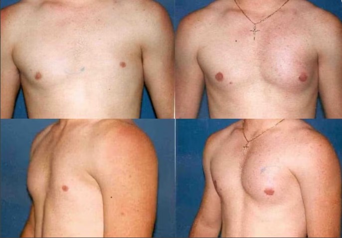 preenchimento peitoral masculino hialuronico preenchimento peitoral masculino hialuronico