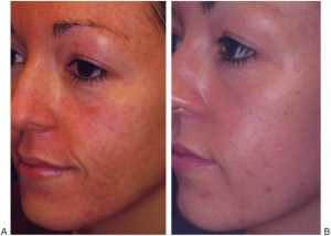 Antes e depois de laser CO2 fracionado com dermatologista — melhora de manchas e textura da pele