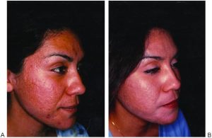 Antes e depois de laser CO2 fracionado com dermatologista — redução de cicatrizes de acne