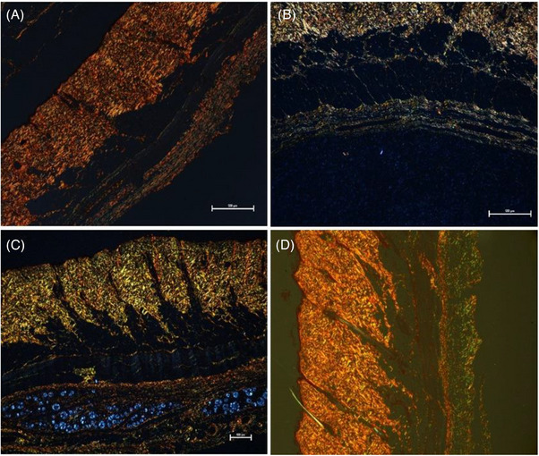 bioestimulador de colágeno no glúteo bioestimulador de colágeno no glúteo: histologia de neocolagênese com PLLA