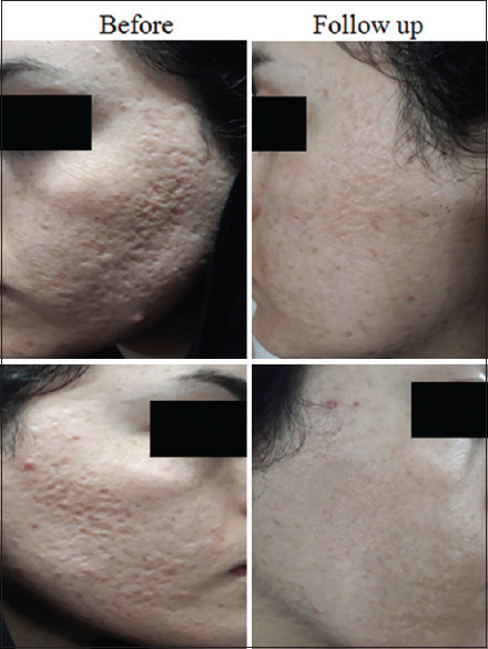 laser CO2 fracionado para cicatriz de acne laser CO2 fracionado para cicatriz de acne