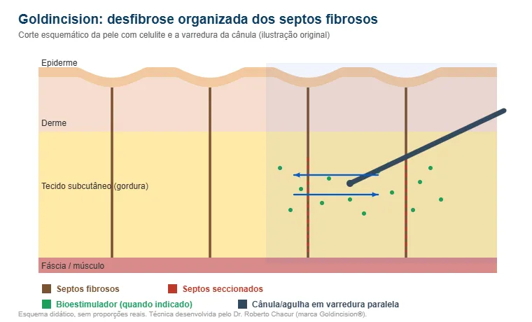 Goldincision como funciona Goldincision como funciona: esquema da desfibrose dos septos fibrosos com a cânula