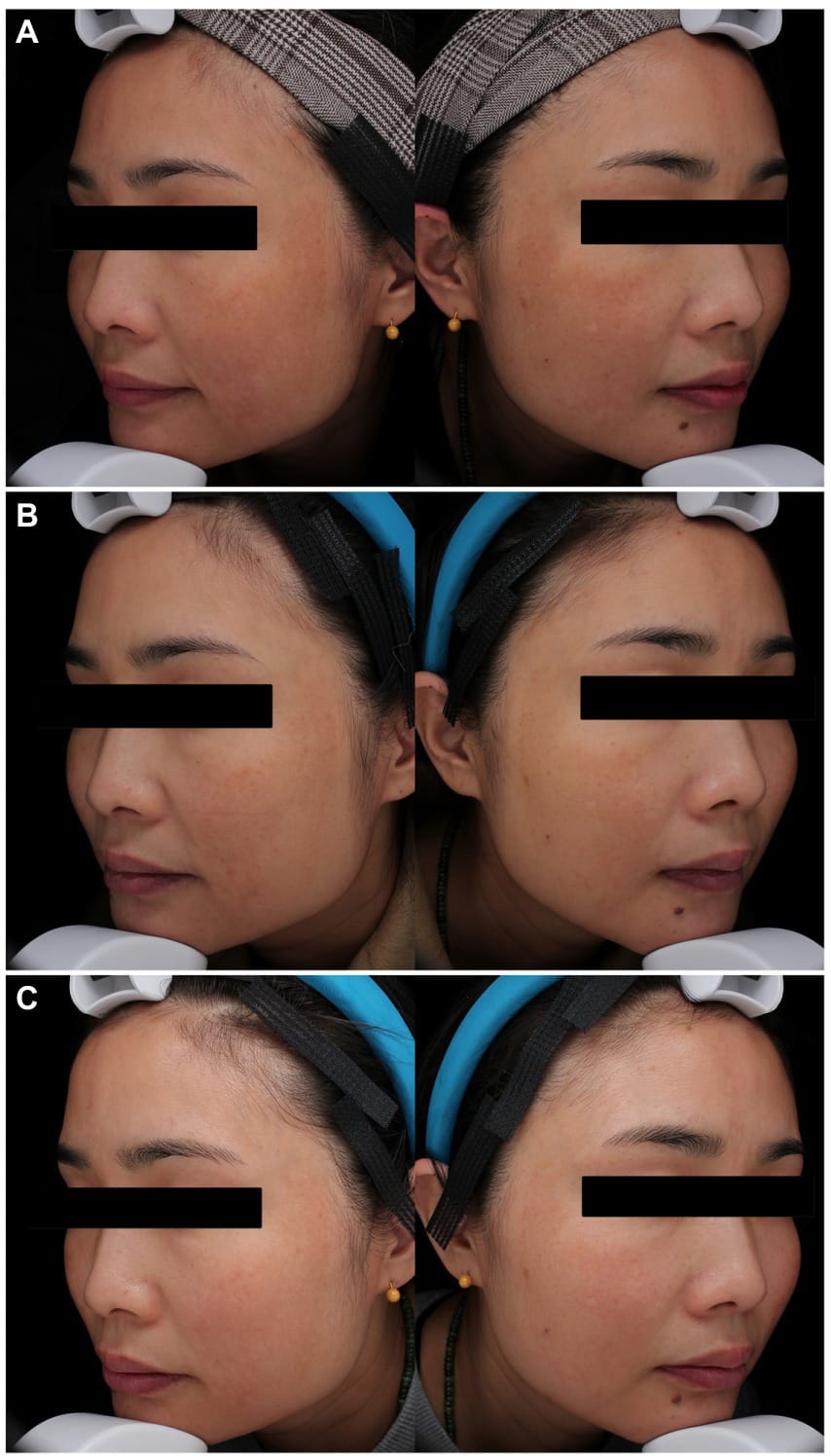 laser picosegundo para melasma Laser picosegundo para melasma: antes e depois em estudo científico