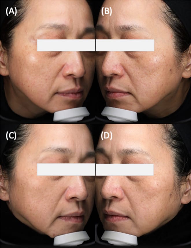 Melasma refratário: antes e depois em estudo científico com radiofrequência e cisteamina