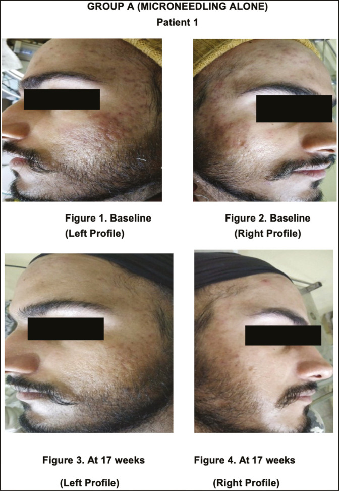 microagulhamento para cicatriz de acne microagulhamento para cicatriz de acne