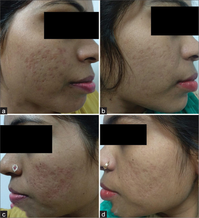 peeling químico para cicatriz de acne peeling químico para cicatriz de acne