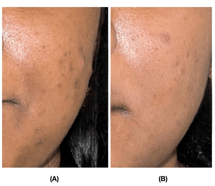 PRP para cicatriz de acne PRP para cicatriz de acne