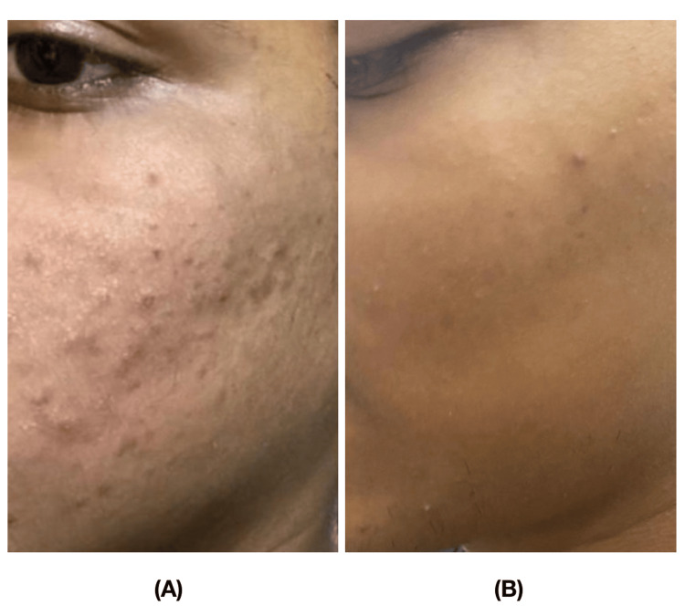PRP para cicatriz de acne PRP para cicatriz de acne combinado com microagulhamento