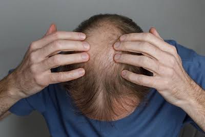 Rarefação capilar e sinais de queda de cabelo no couro cabeludo masculino