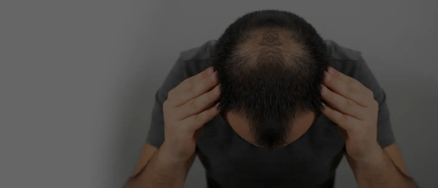Homem com queda de cabelo e calvície buscando tratamentos para queda de cabelo