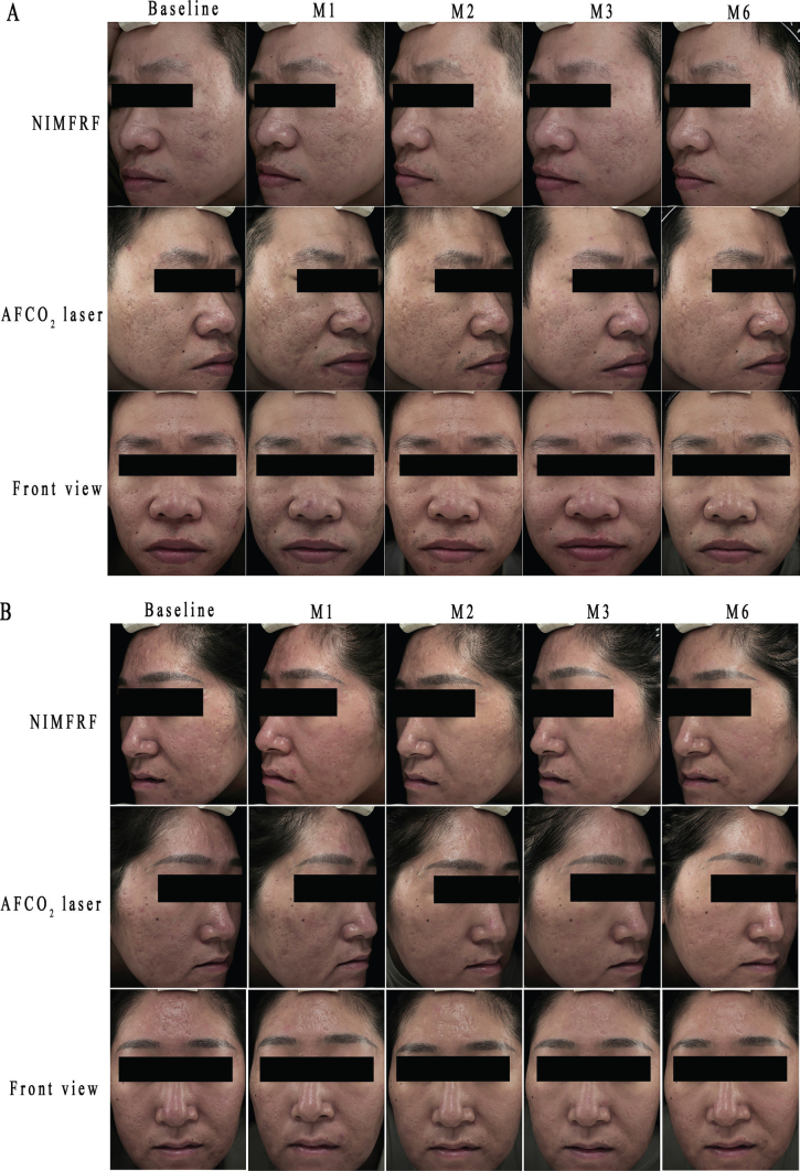 radiofrequência microagulhada para cicatriz de acne radiofrequência microagulhada para cicatriz de acne