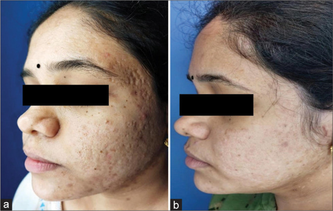 radiofrequência microagulhada para cicatriz de acne radiofrequência microagulhada para cicatriz de acne resultado