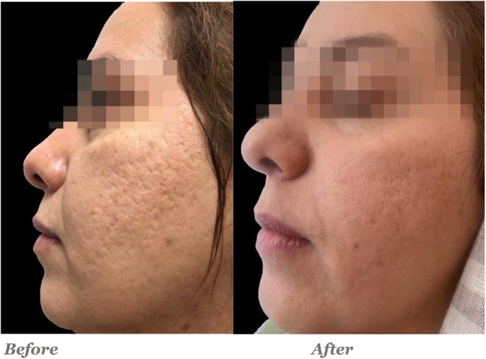 subcisão para cicatriz de acne