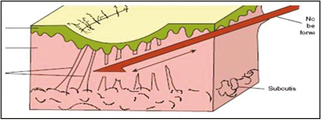 tratamento de cicatriz de acne em são paulo