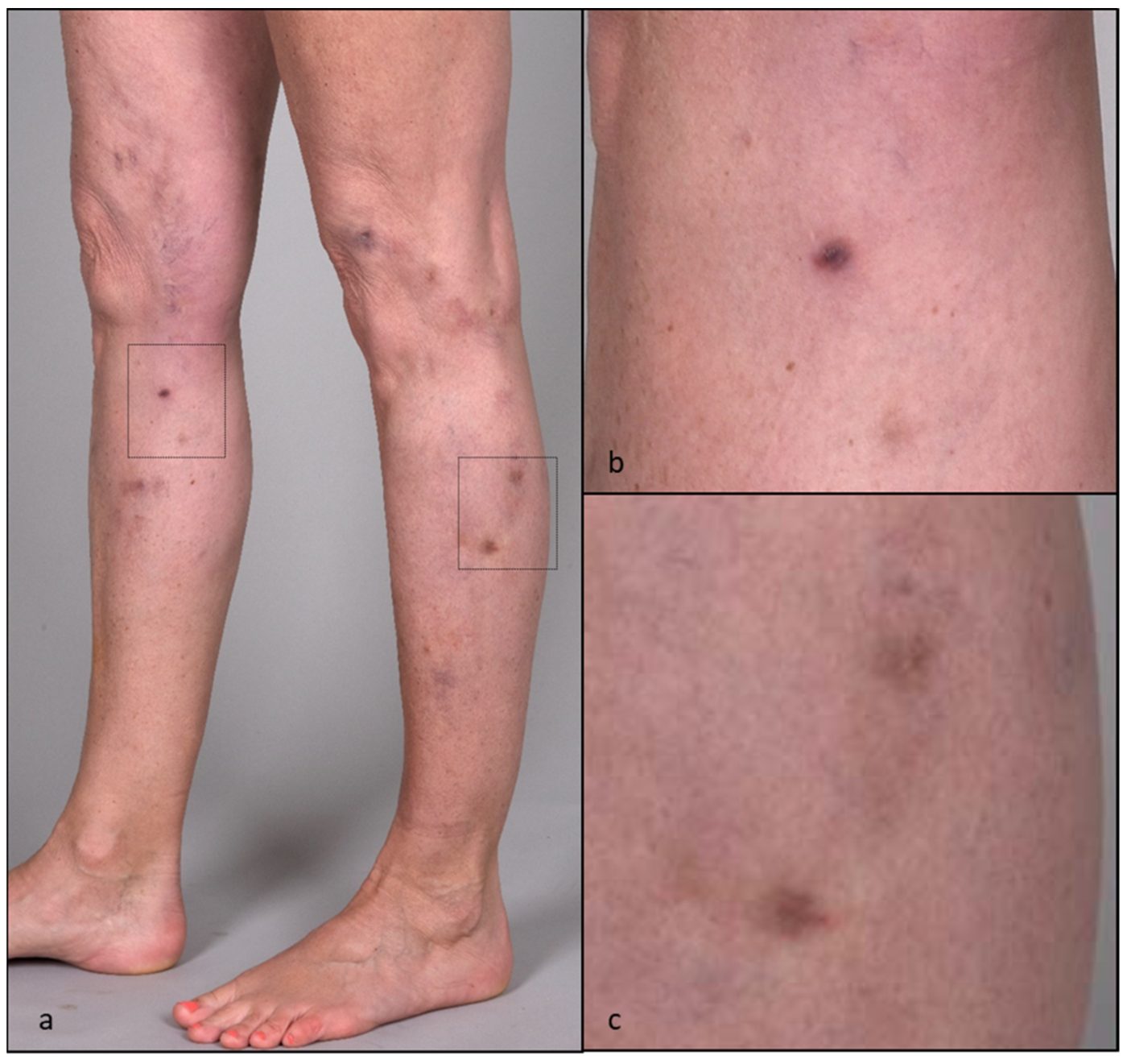 Laser para vasinhos: hiperpigmentacao em pernas apos laser, figura de artigo cientifico