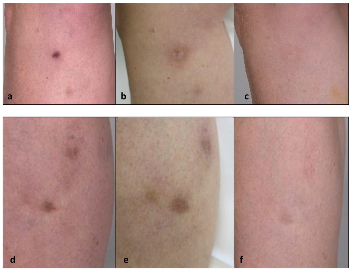 Laser para vasinhos: evolucao do tratamento de manchas com laser Nd:YAG, figura de artigo cientifico