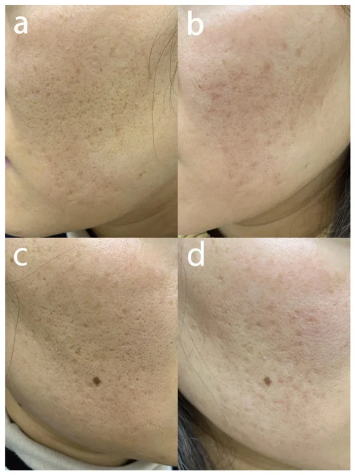 Laser de CO2 antes e depois em cicatriz boxcar e icepick
