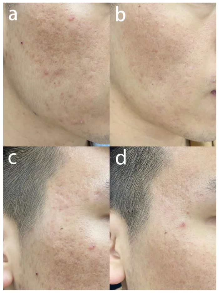 Laser de CO2 antes e depois em cicatriz de acne do tipo rolling