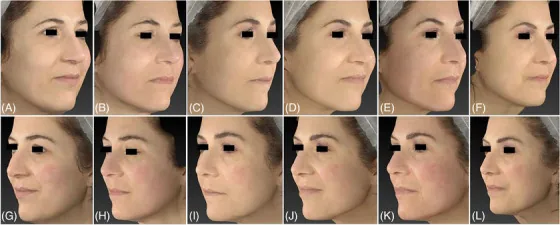 Laser de CO2 antes e depois: rejuvenescimento facial em 1 mês