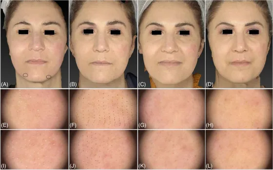 Recuperação do laser de CO2 dia a dia, com dermatoscopia