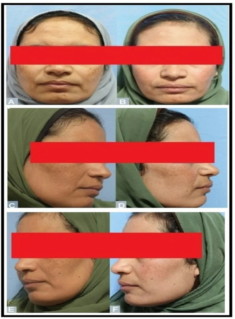 Melasma antes e depois do tratamento com laser de CO2 fracionado e ácido tranexâmico