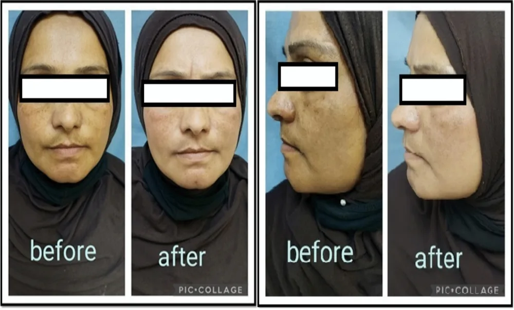 Melasma antes e depois de microagulhamento com ácido tranexâmico tópico